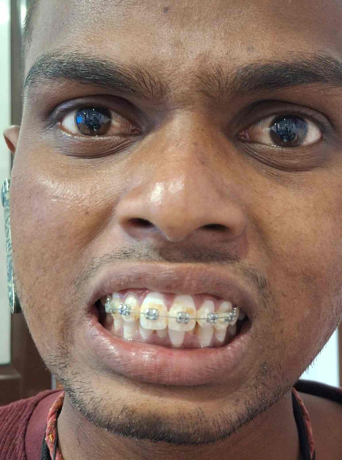 Smile Transformation Case at Neo smile dentocare dental clinic